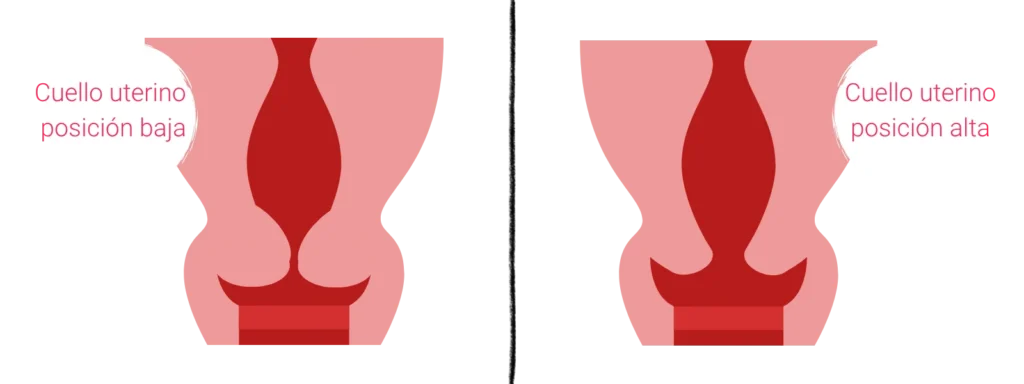 Comparación esquemática de dos cuellos uterinos. El gráfico de la izquierda lleva la leyenda «cuello uterino bajo», mientras que el de la derecha muestra el cuello uterino más arriba y lleva la leyenda «cuello uterino alto».
