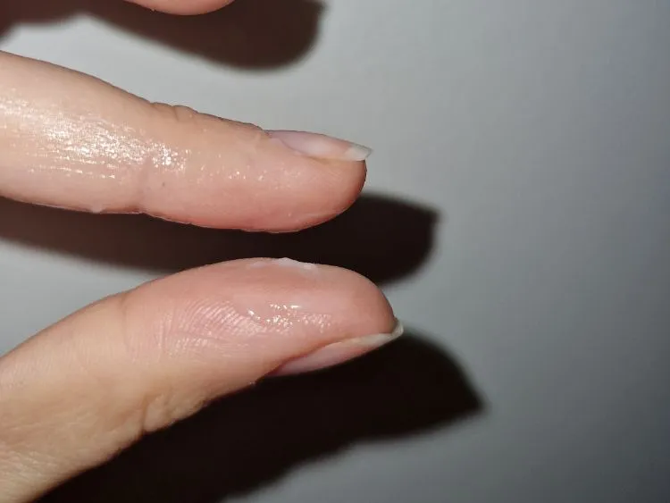 Moco cervical de color blanquecino y cremoso en el día 16 del ciclo (2), tras 6 días de S+, anticoncepción con trackle
